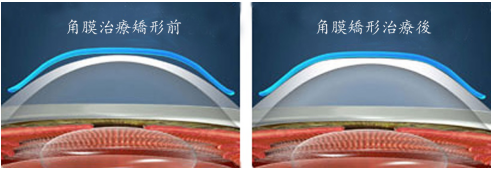 角膜塑形镜治疗效果图