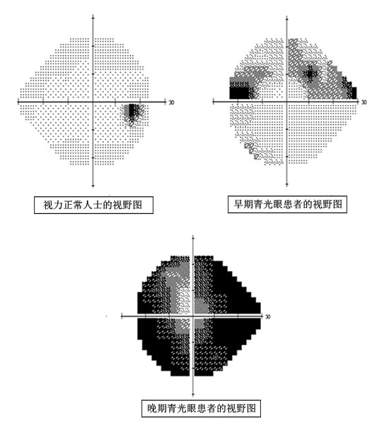 青光眼