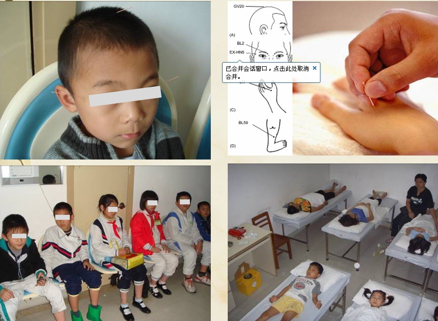 针灸治疗弱视