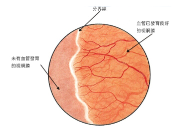早产儿视网膜病