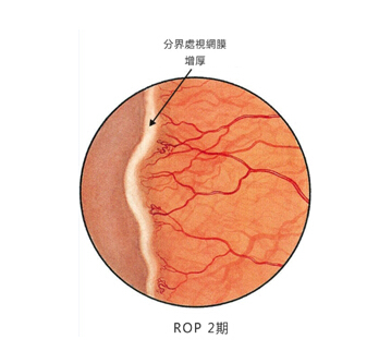 早产儿视网膜病