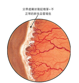 早产儿视网膜病