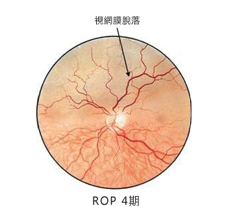 早产儿视网膜病