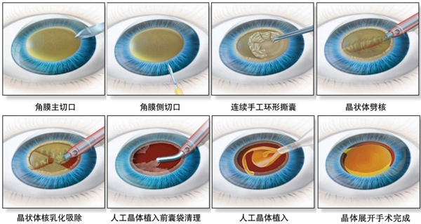 (图示:超声乳化白内障手术过程详解)