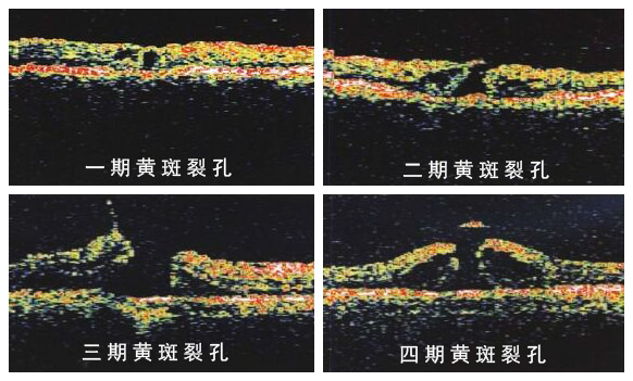 希玛眼科与国际接轨 掌握黄斑裂孔最新治疗动态