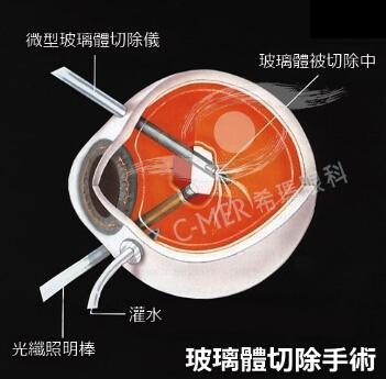 玻璃体切除