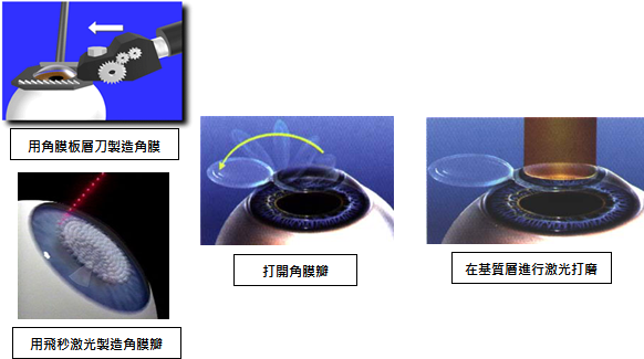 激光矫视步骤