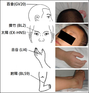 针灸治疗