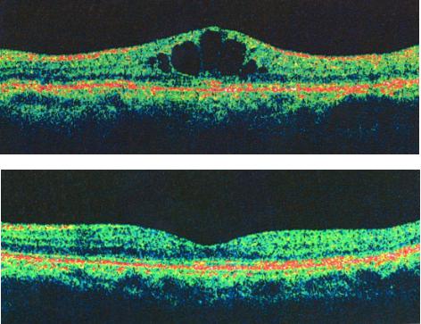 中心性视网膜静脉阻塞