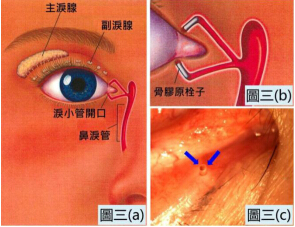 使用可吸收的骨胶原栓子封闭泪小管开口可以保留更多的自身泪液来滋润眼球,协助患者作干眼的治疗测试,若成效理想则可考虑永久封闭泪小管开口来治疗干眼。
