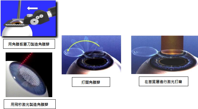 深圳希玛林顺潮眼科医院近视矫正手术