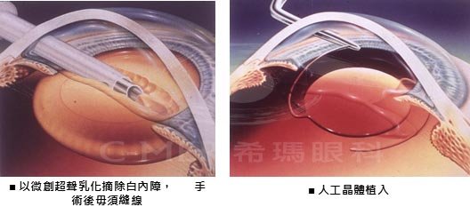 深圳做白内障手术多少钱