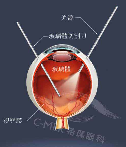 玻璃体切除手术