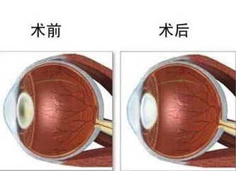 做飞秒激光手术要具备哪些条件