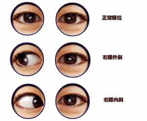 小孩眼睛斜视怎么办