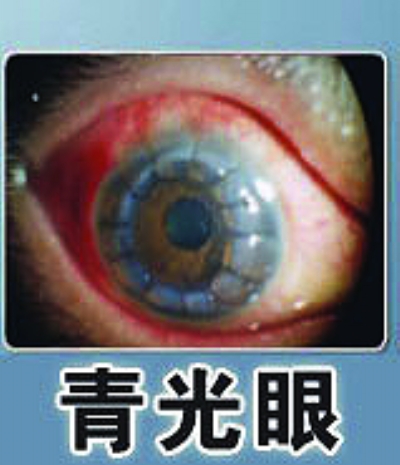 青光眼的危害：患者视力不可逆