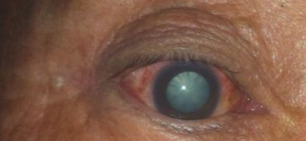 青光眼的病因具体都有哪些