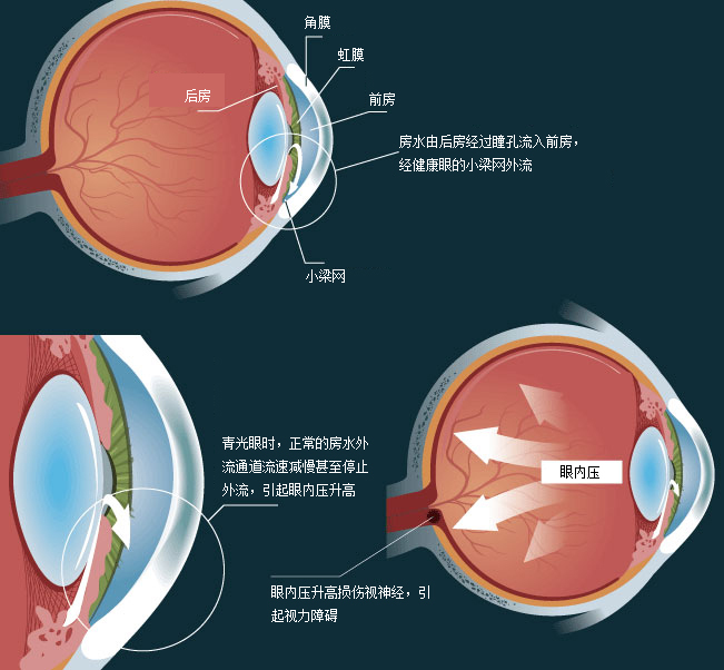 青光眼治疗费用如何确定?