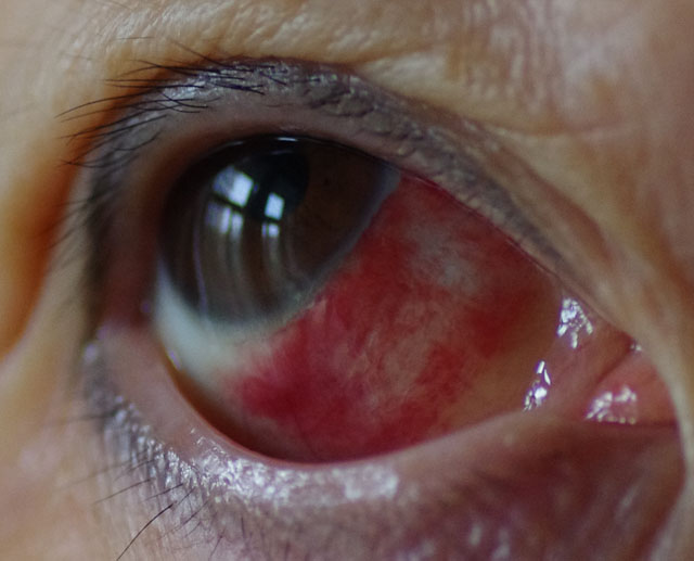 深圳治疗眼底出血医院深圳希玛林顺潮眼科医院