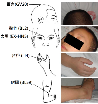 深圳希玛林顺潮眼科医院中医针灸