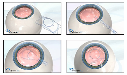 高度近视矫正的较好方案——ICL晶体植入