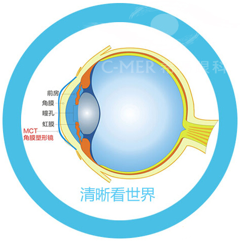 儿童近视配戴什么类型眼镜好？