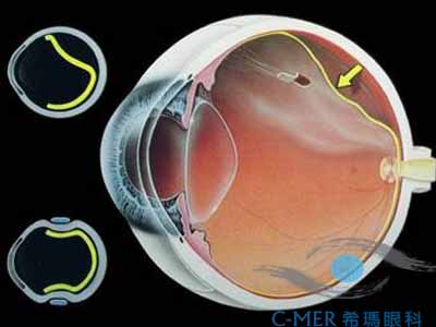 视网膜脱离的危害