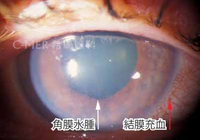 深圳青光眼的检查