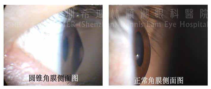 锥形角膜的治疗