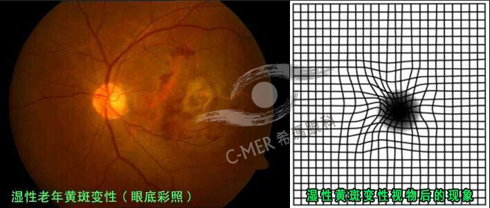 黄斑变性有哪些症状