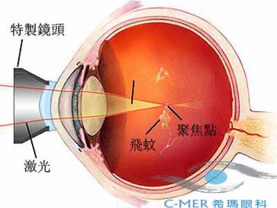 玻璃体混浊怎么治疗效果好？