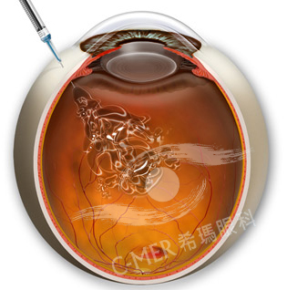 黄斑水肿的症状及治疗