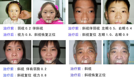 儿童斜视好治疗吗