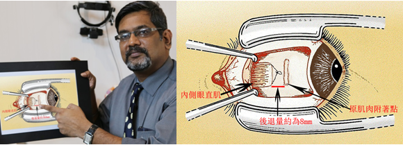 小孩斜视手术治疗