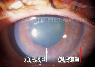 眼痛,头痛恶心,青光眼