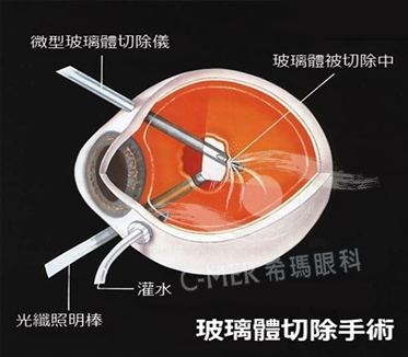 黄斑病变治疗医院哪家好