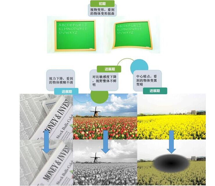什么,是,黄斑,变性,如何,应对,许多,到了,一定, 什么,是,黄斑,变性,如何,应对,许多,到了,一定,