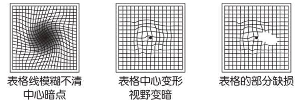 什么,是,黄斑,变性,如何,应对,许多,到了,一定, 什么,是,黄斑,变性,如何,应对,许多,到了,一定,