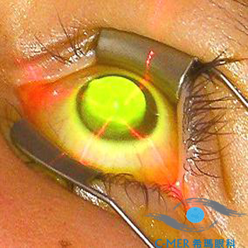 胶原交联术,锥形角膜