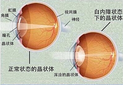 白内障——是晶状体发生混浊了