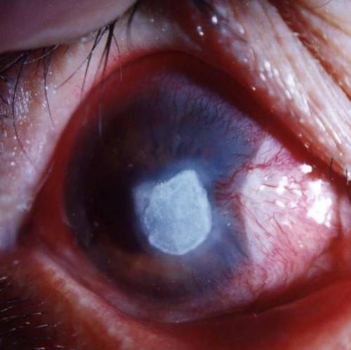 角膜溃疡疾病,治疗 角膜溃疡疾病,治疗