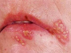 疱疹性病毒性角膜炎