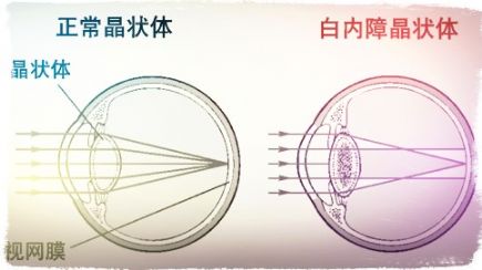 还在单纯治疗白内障吗? 希玛步入“屈光性手术”时代