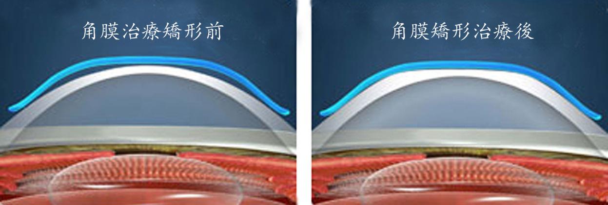 【家长必读】怎样看电视小孩不容易得近视眼