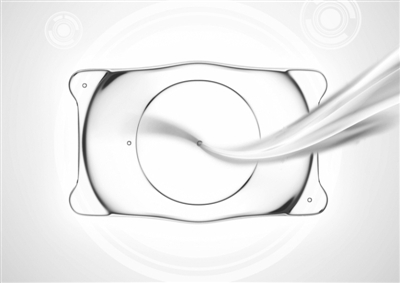 V4c晶体治疗高度近视，房水流动自然