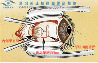 儿童斜视趁早做手术是误区