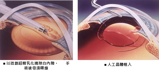 【白内障的治疗】人工晶体如何选择？