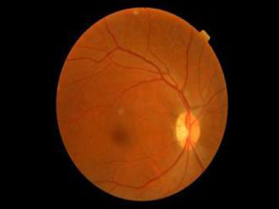 中心视力加速下降，警惕黄斑裂孔