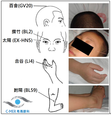 6岁前，是治疗弱视的黄金时期