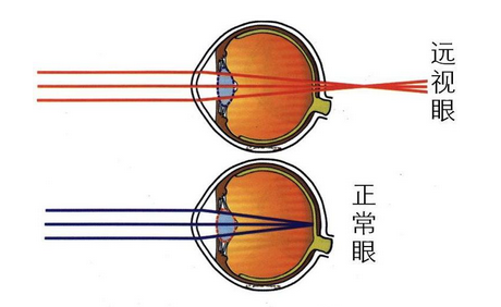 什么是儿童远视，如何治？